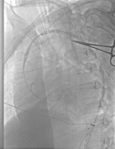 动脉长鞘怎么置入【弓部重建直通车】真腔难觅，另辟蹊径｜潍坊市人民医院血管外科运用Castor®支架结合长鞘建立导丝通路治疗主动脉夹层两例_https://www.jmylbn.com_新闻资讯_第17张