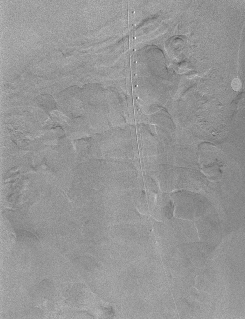 动脉长鞘怎么置入【弓部重建直通车】真腔难觅，另辟蹊径｜潍坊市人民医院血管外科运用Castor®支架结合长鞘建立导丝通路治疗主动脉夹层两例_https://www.jmylbn.com_新闻资讯_第19张