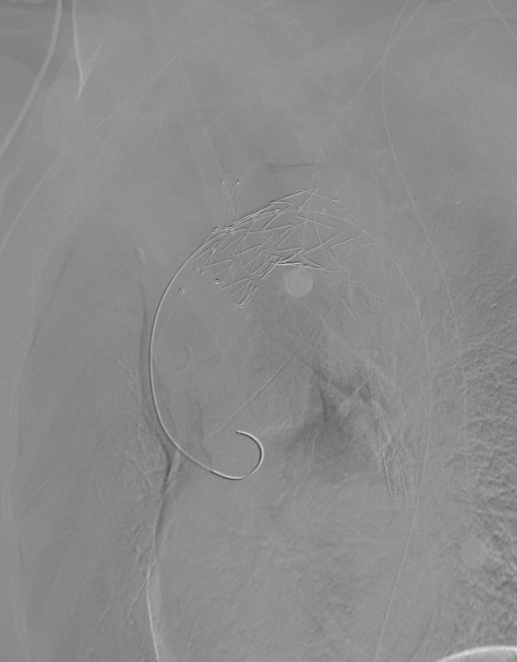 动脉长鞘怎么置入【弓部重建直通车】真腔难觅，另辟蹊径｜潍坊市人民医院血管外科运用Castor®支架结合长鞘建立导丝通路治疗主动脉夹层两例_https://www.jmylbn.com_新闻资讯_第11张