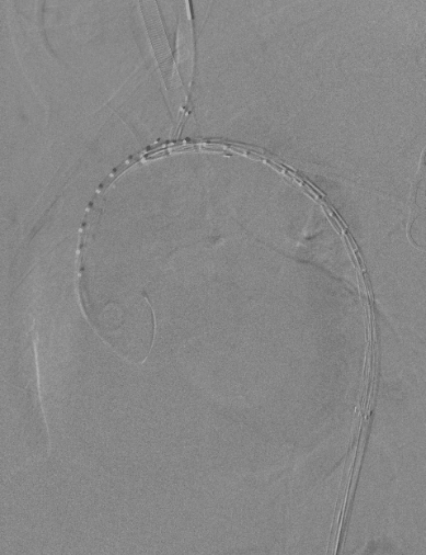 动脉长鞘怎么置入【弓部重建直通车】真腔难觅，另辟蹊径｜潍坊市人民医院血管外科运用Castor®支架结合长鞘建立导丝通路治疗主动脉夹层两例_https://www.jmylbn.com_新闻资讯_第16张