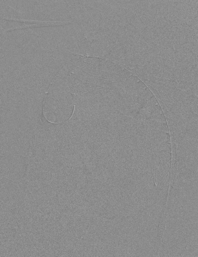 动脉长鞘怎么置入【弓部重建直通车】真腔难觅，另辟蹊径｜潍坊市人民医院血管外科运用Castor®支架结合长鞘建立导丝通路治疗主动脉夹层两例_https://www.jmylbn.com_新闻资讯_第18张