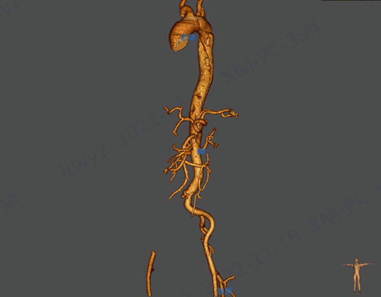 动脉长鞘怎么置入【弓部重建直通车】真腔难觅，另辟蹊径｜潍坊市人民医院血管外科运用Castor®支架结合长鞘建立导丝通路治疗主动脉夹层两例_https://www.jmylbn.com_新闻资讯_第12张