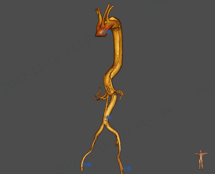 动脉长鞘怎么置入【弓部重建直通车】真腔难觅，另辟蹊径｜潍坊市人民医院血管外科运用Castor®支架结合长鞘建立导丝通路治疗主动脉夹层两例_https://www.jmylbn.com_新闻资讯_第4张