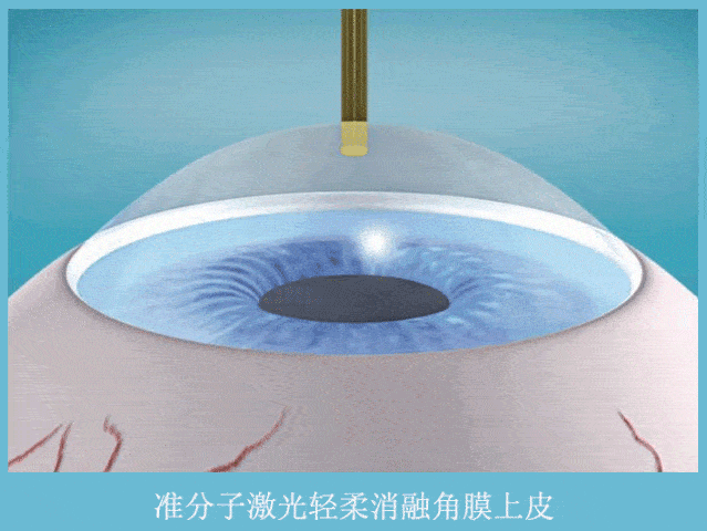 smart怎么治SMART全激光治疗近视！你需要了解这些_https://www.jmylbn.com_新闻资讯_第2张