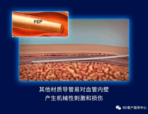 留置针型号怎么区分留置针到底怎么选，型号材质不纠结_https://www.jmylbn.com_新闻资讯_第14张