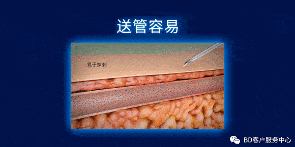 留置针型号怎么区分留置针到底怎么选，型号材质不纠结_https://www.jmylbn.com_新闻资讯_第6张