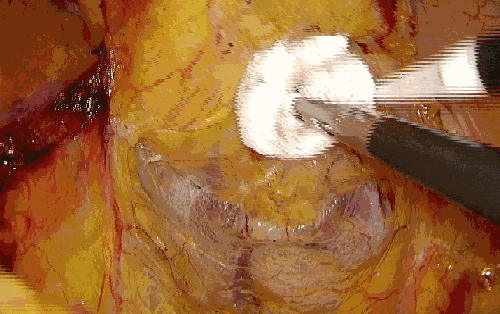 纱布片怎么使用方法腔镜手术中软纱布有什么用_https://www.jmylbn.com_新闻资讯_第4张