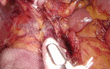 纱布片怎么使用方法腔镜手术中软纱布有什么用_https://www.jmylbn.com_新闻资讯_第6张