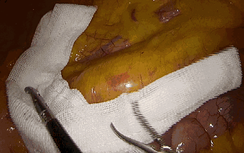 纱布片怎么使用方法腔镜手术中软纱布有什么用_https://www.jmylbn.com_新闻资讯_第2张