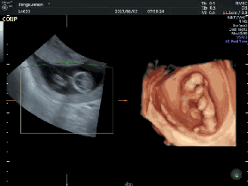 汕头彩超怎么样孕期做四维彩超发现宝宝竟是大长腿？你的关心用错了地方！｜ 汕头妇产科医院_https://www.jmylbn.com_新闻资讯_第13张