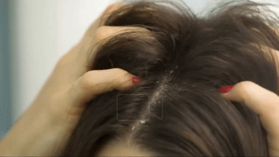 头皮发痒?疯狂出油?原来你的头皮上竟然活跃着这个