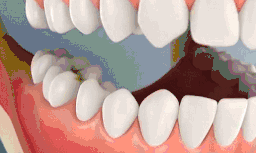 嵌体修复——比传统补牙更好的选择