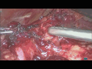 手术吸引器怎么用手术操作技巧：如何用好腹腔镜下的那根“棍”_https://www.jmylbn.com_新闻资讯_第3张