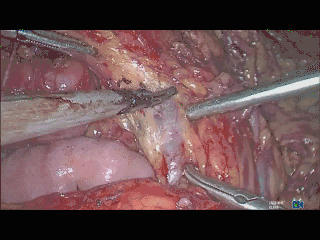 吸引器怎么使用手术兵器谱篇——使用腹腔镜下那根“棍”的招式攻略_https://www.jmylbn.com_新闻资讯_第8张