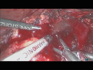 吸引器怎么使用手术兵器谱篇——使用腹腔镜下那根“棍”的招式攻略_https://www.jmylbn.com_新闻资讯_第5张