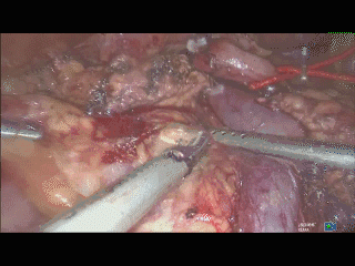 手术吸引器怎么用手术操作技巧：如何用好腹腔镜下的那根“棍”_https://www.jmylbn.com_新闻资讯_第5张