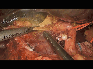 手术吸引器怎么用手术操作技巧：如何用好腹腔镜下的那根“棍”_https://www.jmylbn.com_新闻资讯_第7张