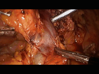 手术吸引器怎么用手术操作技巧：如何用好腹腔镜下的那根“棍”_https://www.jmylbn.com_新闻资讯_第4张