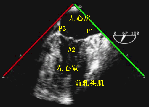 彩超探头怎么转换经食道心脏彩超（TEE）总看不懂？5 分钟掌握经典切面！（附动图）_https://www.jmylbn.com_新闻资讯_第13张