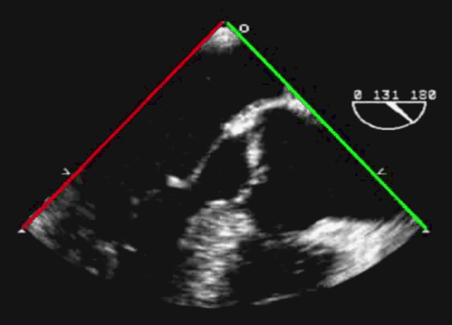 彩超探头怎么转换经食道心脏彩超（TEE）总看不懂？5 分钟掌握经典切面！（附动图）_https://www.jmylbn.com_新闻资讯_第18张