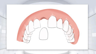 全口无牙，难道要种28颗种植体吗？