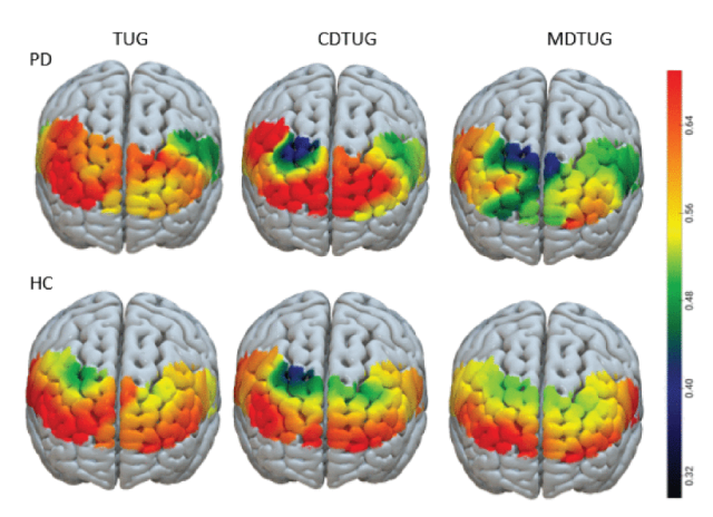 帕金森病患者的脑 - 体交互：双任务表现研究揭示新机制