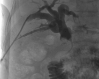 引流袋管子怎么不流告别引流袋，老人的心愿终于实现！_https://www.jmylbn.com_新闻资讯_第7张