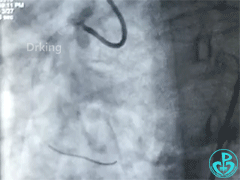 泥鳅导丝怎么用泥鳅导丝又惹祸，股动脉分支破裂要堵上！_https://www.jmylbn.com_新闻资讯_第2张