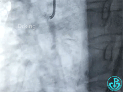 泥鳅导丝怎么用泥鳅导丝又惹祸，股动脉分支破裂要堵上！_https://www.jmylbn.com_新闻资讯_第1张