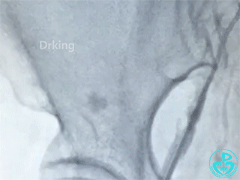 泥鳅导丝怎么用泥鳅导丝又惹祸，股动脉分支破裂要堵上！_https://www.jmylbn.com_新闻资讯_第3张