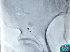 泥鳅导丝怎么用泥鳅导丝又惹祸，股动脉分支破裂要堵上！_https://www.jmylbn.com_新闻资讯_第5张