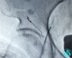 泥鳅导丝怎么用泥鳅导丝又惹祸，股动脉分支破裂要堵上！_https://www.jmylbn.com_新闻资讯_第6张