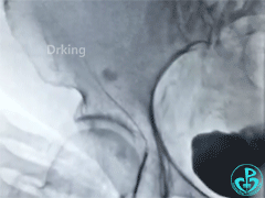 泥鳅导丝怎么用泥鳅导丝又惹祸，股动脉分支破裂要堵上！_https://www.jmylbn.com_新闻资讯_第4张