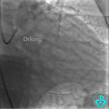 为什么要用到微导管操作演示：双腔微导管在重度扭曲病变中的使用，非常有效！_https://www.jmylbn.com_新闻资讯_第16张