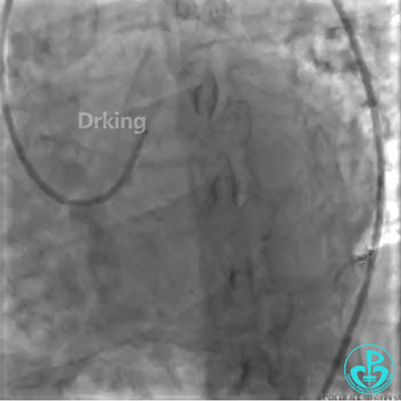 为什么要用到微导管操作演示：双腔微导管在重度扭曲病变中的使用，非常有效！_https://www.jmylbn.com_新闻资讯_第17张