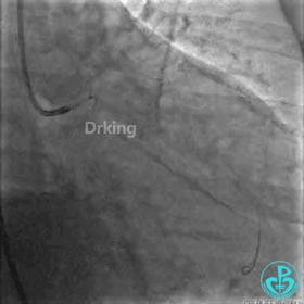 为什么要用到微导管操作演示：双腔微导管在重度扭曲病变中的使用，非常有效！_https://www.jmylbn.com_新闻资讯_第6张