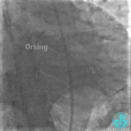 为什么要用到微导管操作演示：双腔微导管在重度扭曲病变中的使用，非常有效！_https://www.jmylbn.com_新闻资讯_第14张