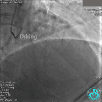 为什么要用到微导管操作演示：双腔微导管在重度扭曲病变中的使用，非常有效！_https://www.jmylbn.com_新闻资讯_第2张