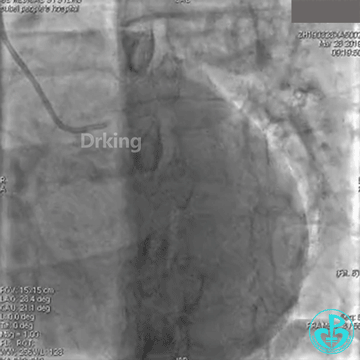 为什么要用到微导管操作演示：双腔微导管在重度扭曲病变中的使用，非常有效！_https://www.jmylbn.com_新闻资讯_第3张