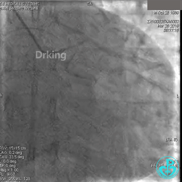 为什么要用到微导管操作演示：双腔微导管在重度扭曲病变中的使用，非常有效！_https://www.jmylbn.com_新闻资讯_第1张