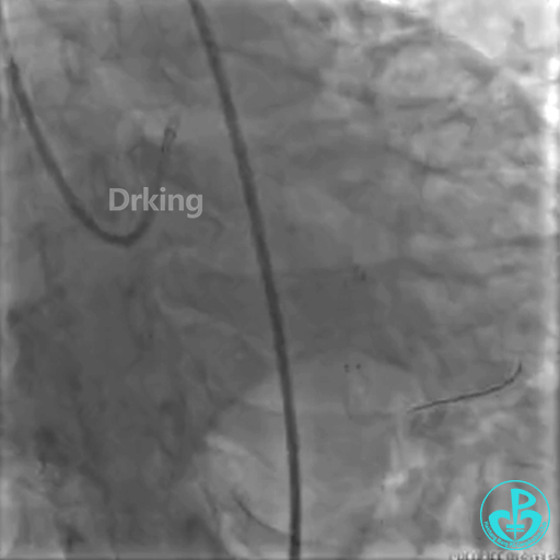 为什么要用到微导管操作演示：双腔微导管在重度扭曲病变中的使用，非常有效！_https://www.jmylbn.com_新闻资讯_第12张