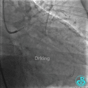 为什么要用到微导管操作演示：双腔微导管在重度扭曲病变中的使用，非常有效！_https://www.jmylbn.com_新闻资讯_第7张