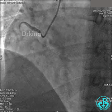 为什么要用到微导管操作演示：双腔微导管在重度扭曲病变中的使用，非常有效！_https://www.jmylbn.com_新闻资讯_第4张