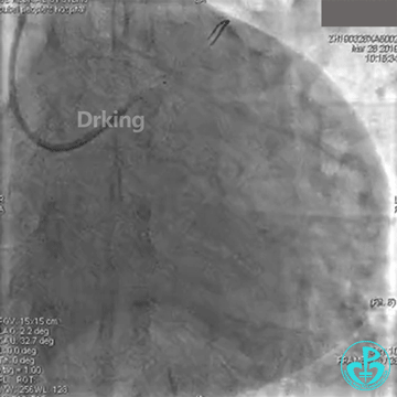 为什么要用到微导管操作演示：双腔微导管在重度扭曲病变中的使用，非常有效！_https://www.jmylbn.com_新闻资讯_第5张