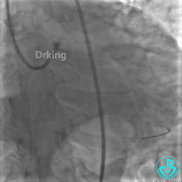 为什么要用到微导管操作演示：双腔微导管在重度扭曲病变中的使用，非常有效！_https://www.jmylbn.com_新闻资讯_第15张