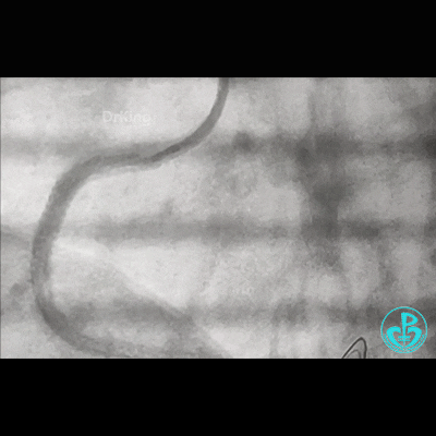 导丝怎么扩右冠近段弥漫性病变中远段闭塞顺利开通并植入支架，哪知道故事才刚刚开始！！！_https://www.jmylbn.com_新闻资讯_第26张