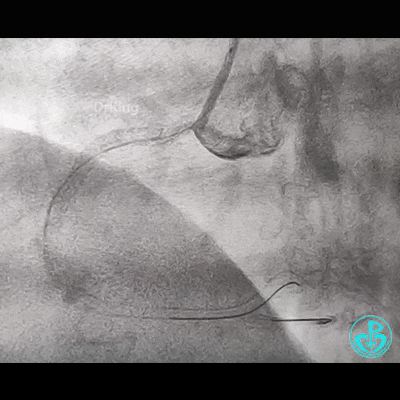 导丝怎么扩右冠近段弥漫性病变中远段闭塞顺利开通并植入支架，哪知道故事才刚刚开始！！！_https://www.jmylbn.com_新闻资讯_第11张