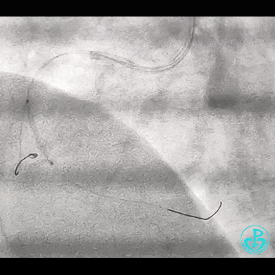 导丝怎么扩右冠近段弥漫性病变中远段闭塞顺利开通并植入支架，哪知道故事才刚刚开始！！！_https://www.jmylbn.com_新闻资讯_第4张