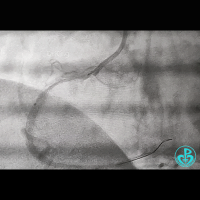 导丝怎么扩右冠近段弥漫性病变中远段闭塞顺利开通并植入支架，哪知道故事才刚刚开始！！！_https://www.jmylbn.com_新闻资讯_第8张