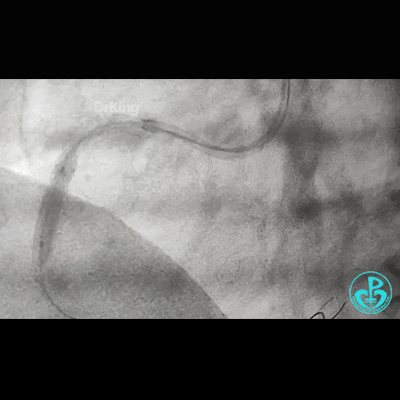 导丝怎么扩右冠近段弥漫性病变中远段闭塞顺利开通并植入支架，哪知道故事才刚刚开始！！！_https://www.jmylbn.com_新闻资讯_第19张
